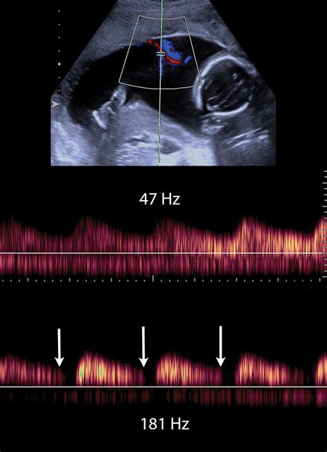 doppler maternaler gefäße|A Radiologist’s Guide to the Performance and。